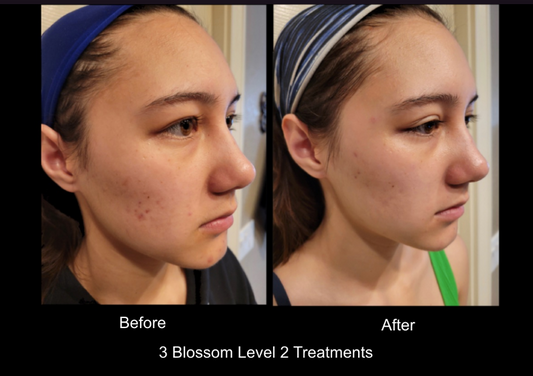 Microchannel & ultraDerm Complementary Demonstrations